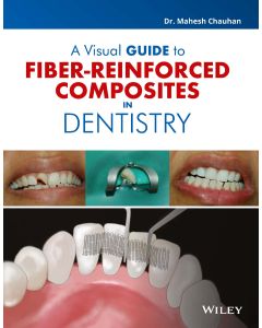 A Visual Guide to Fiber - Reinforced Composites in Dentistry